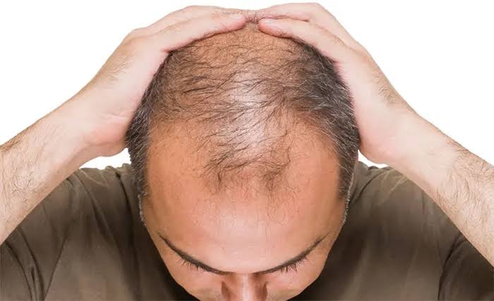 ৩০ বছর বয়সে টাক, প্রতিকারের উপায়